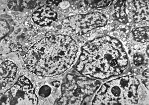 M,55y. | small cell carcinoma - lung M,55y. | small cell carcinoma - lung
